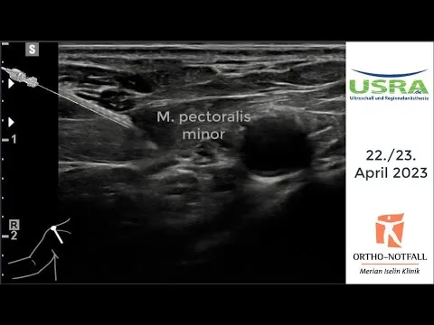 Infraclaviculäre Blockade des Plexus brachialis
