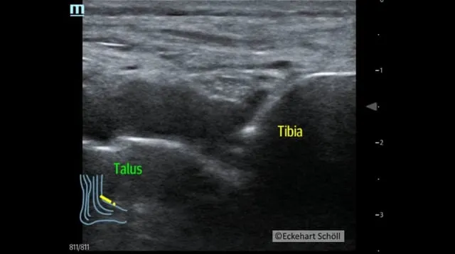 Punktion einer purulenten Arthritis des oberen Sprunggelenkes