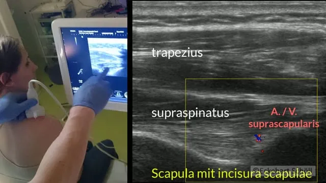 Regio suprascapularis