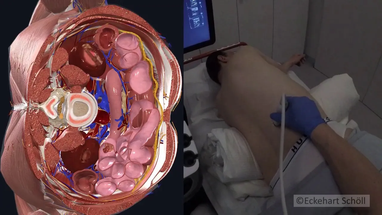 Sonographische Darstellung des Plexus lumbalis